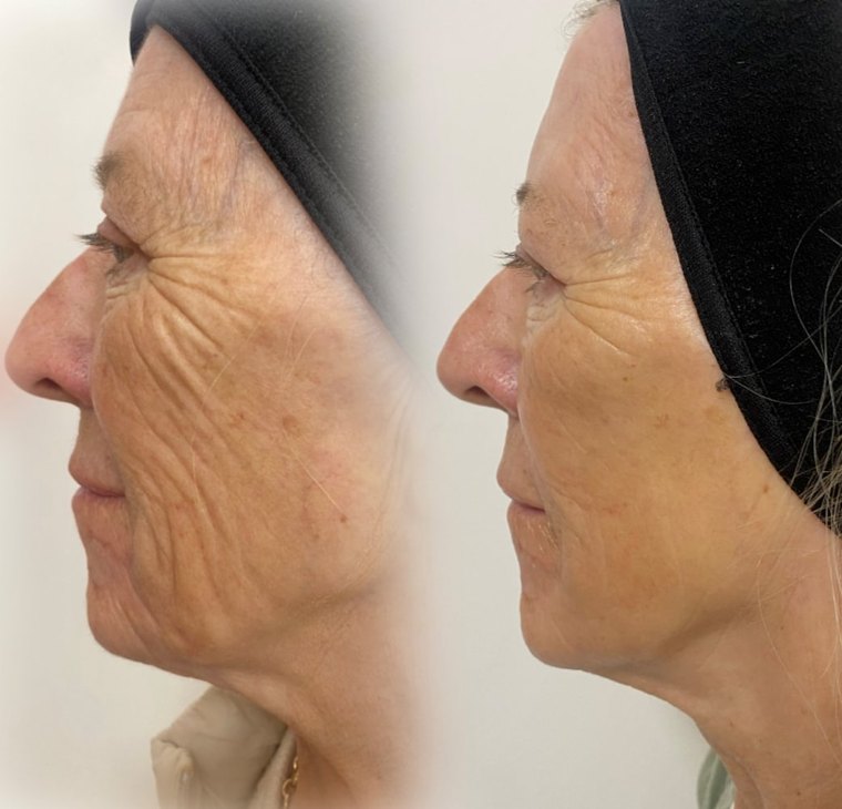 NeoGen result after two treatments at 0.7J, by Body Sculpt Aesthetics