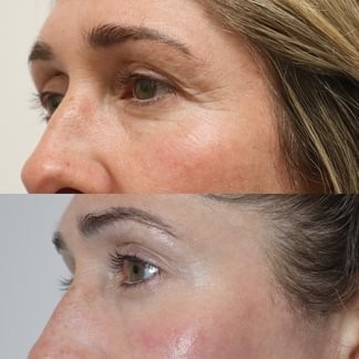 NeoGen eye area result after three treatments at 1.2J, by The Clinic by La Ross