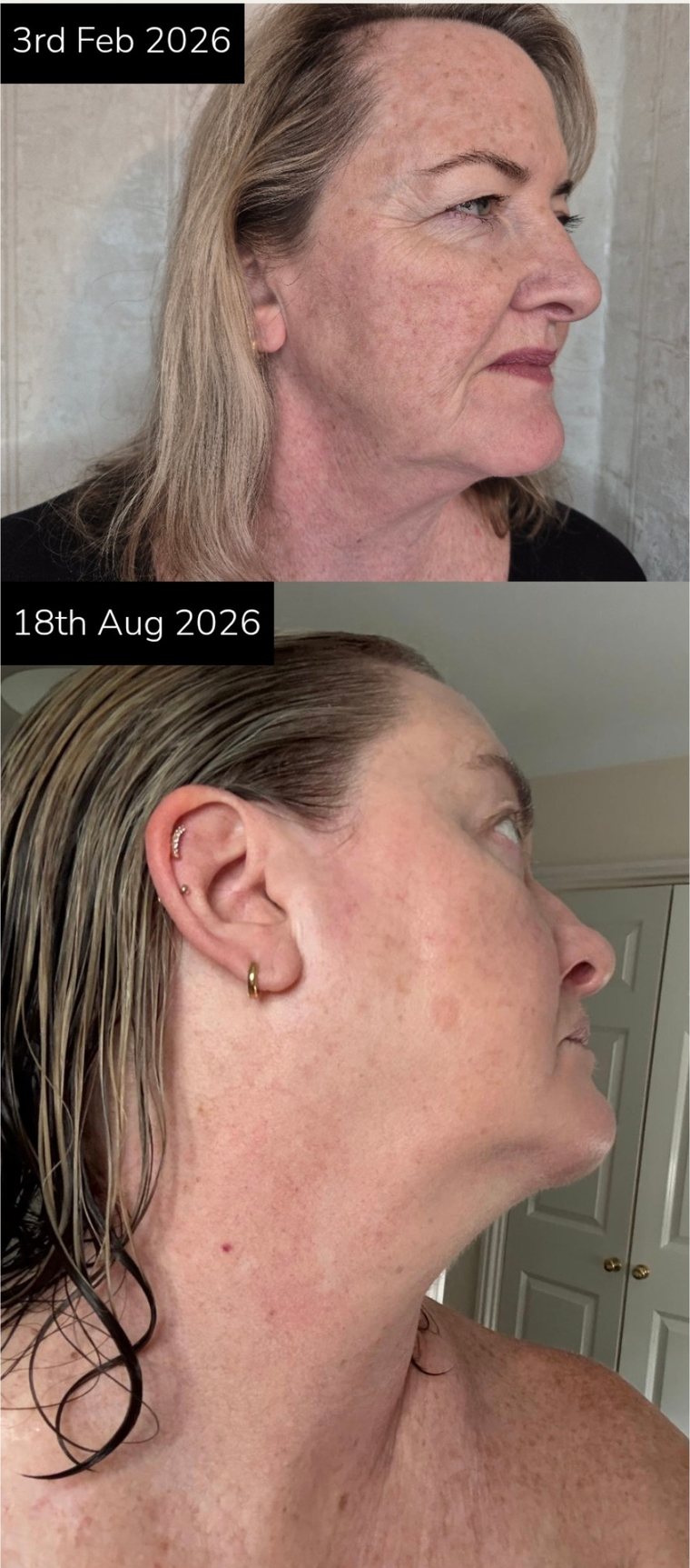 TD Aesthetics NeoGen patient, February to August 2026, profile