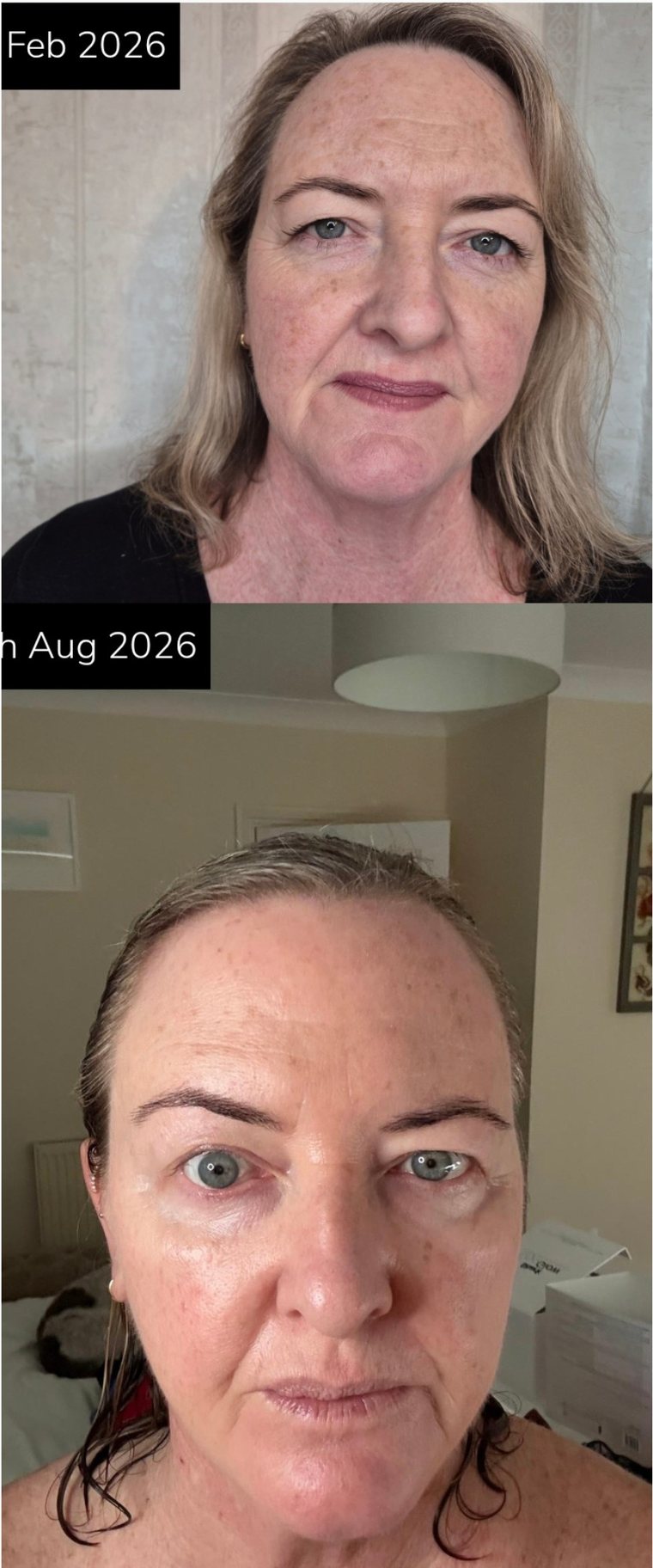 TD Aesthetics NeoGen patient, February to August 2026, front